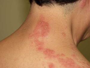 Herpes Treatment Use For Valtrex 